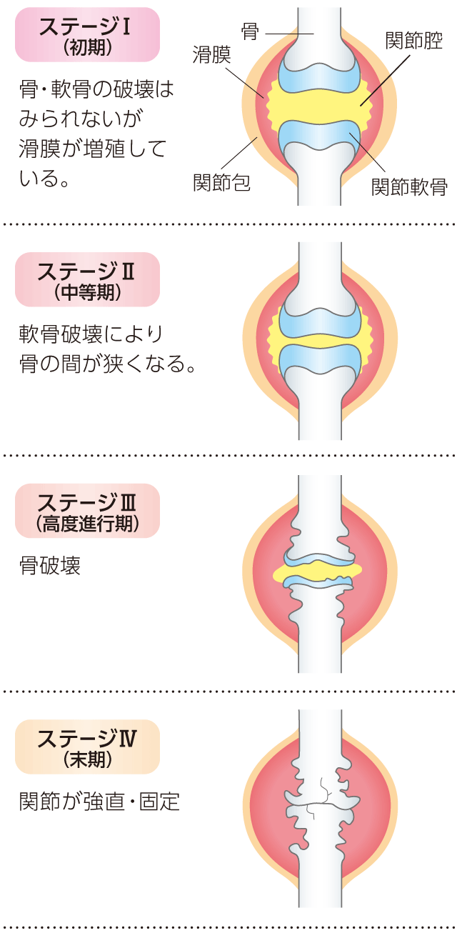 関節破壊の進行度(ステージ)